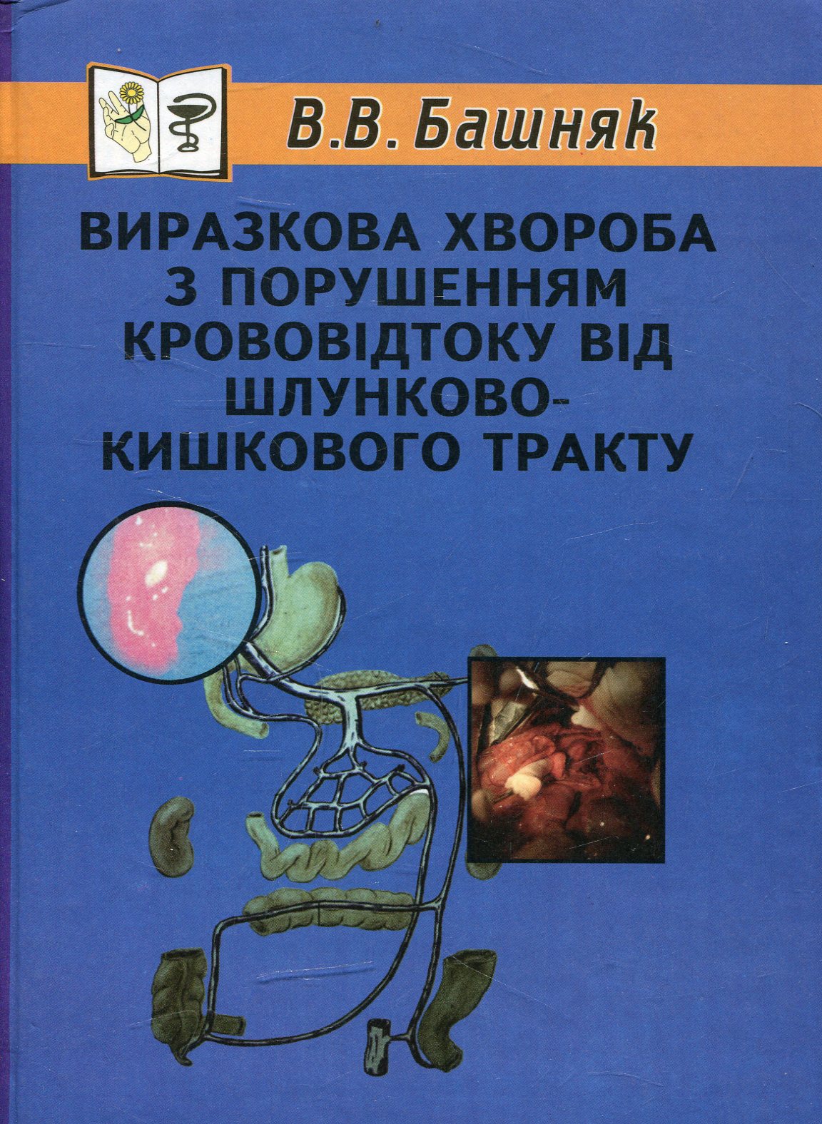 Виразкова хвороба з порушенням крововідтоку від шлунково-кишкового тракту